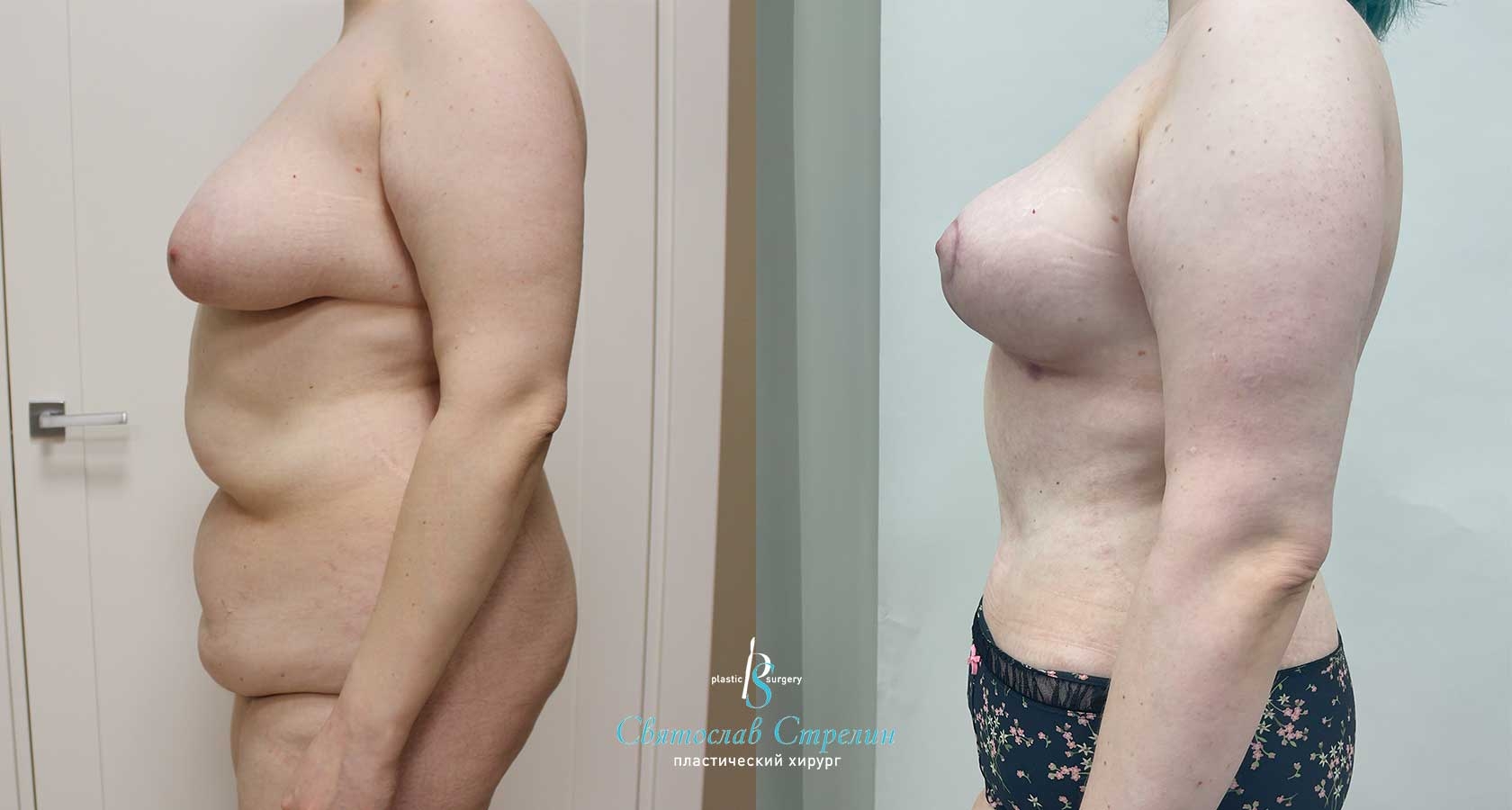 Абдоминопластика, Vaser-липосакция, подтяжка груди, 2 месяца после операции