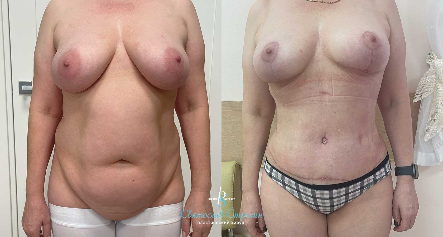 Абдоминопластика, Vaser-липосакция, подтяжка груди, 1 месяц после операции