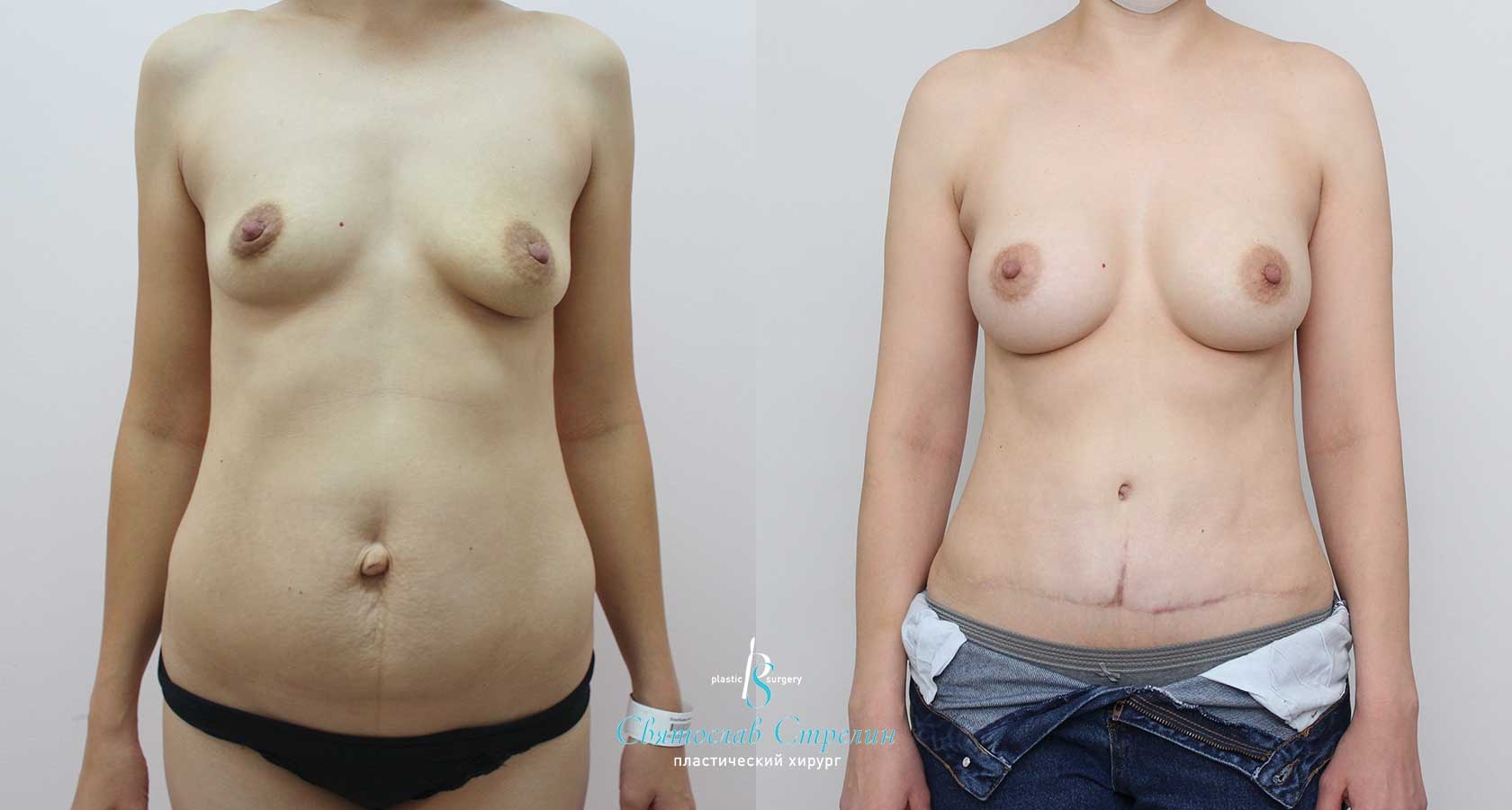 Абдоминопластика, удаление пупочной грыжи, увеличение груди, 8 месяцев после операции