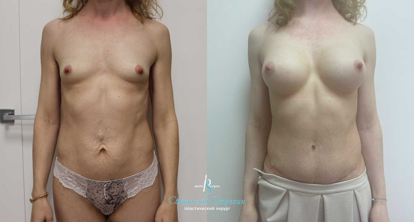 Абдоминопластика, увеличение груди через подмышечный доступ, 6 месяцев после операции