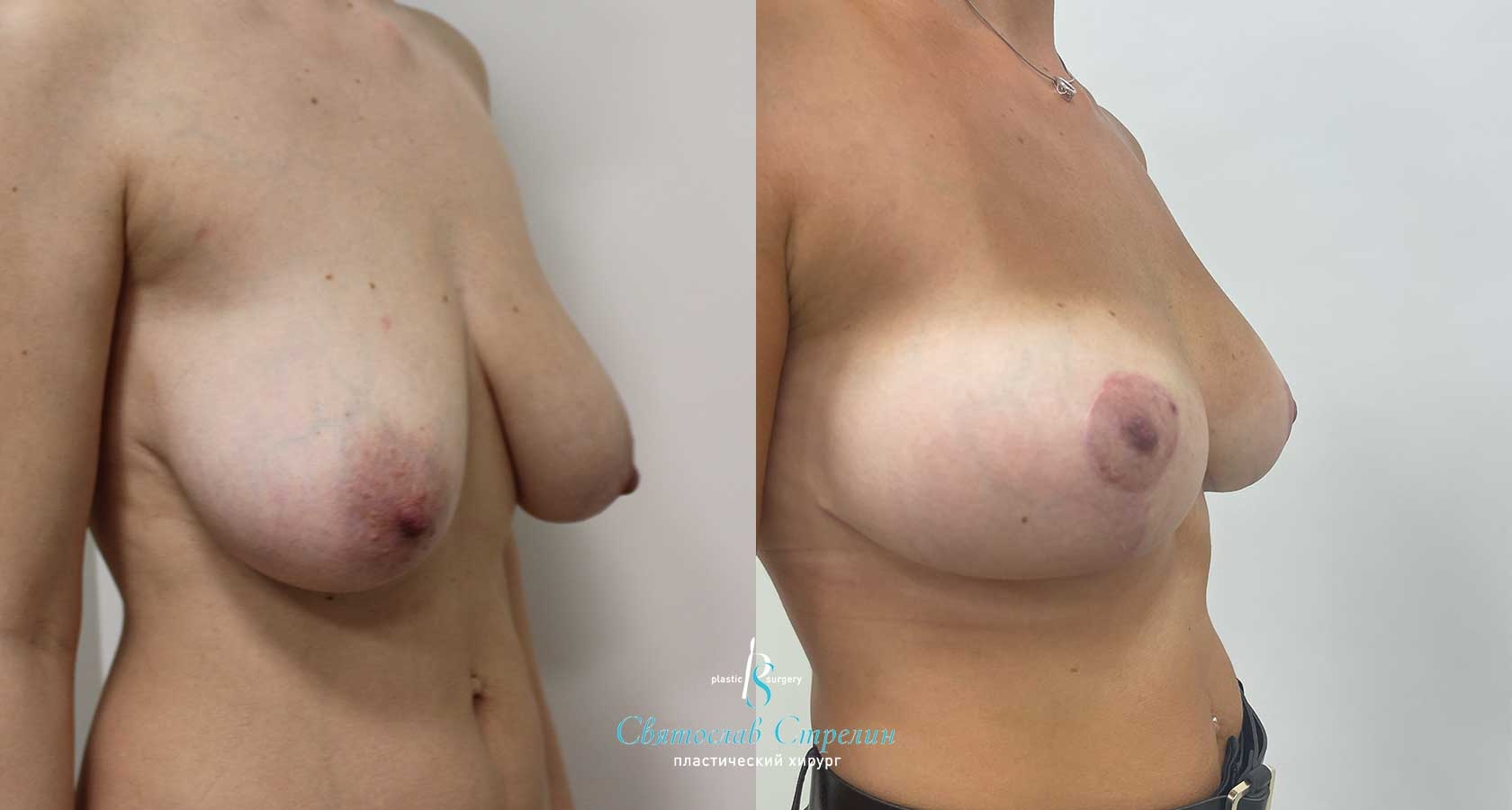 Подтяжка груди, 6 месяцев после операции