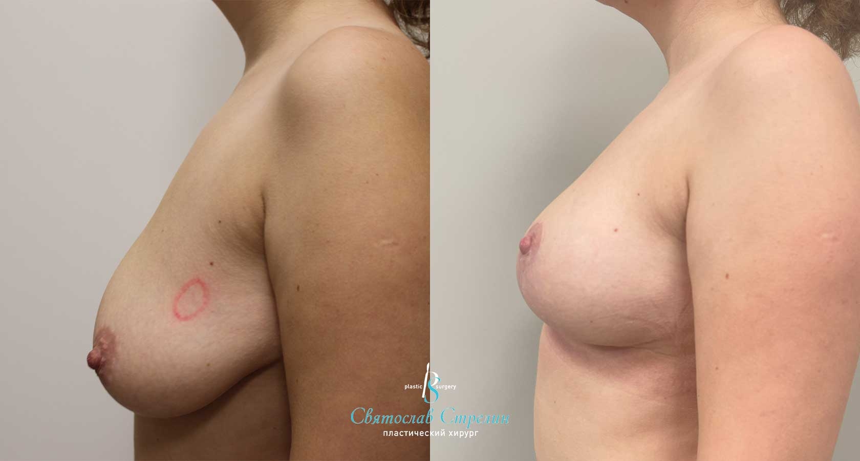 	 Подтяжка груди, 2 месяца после операции