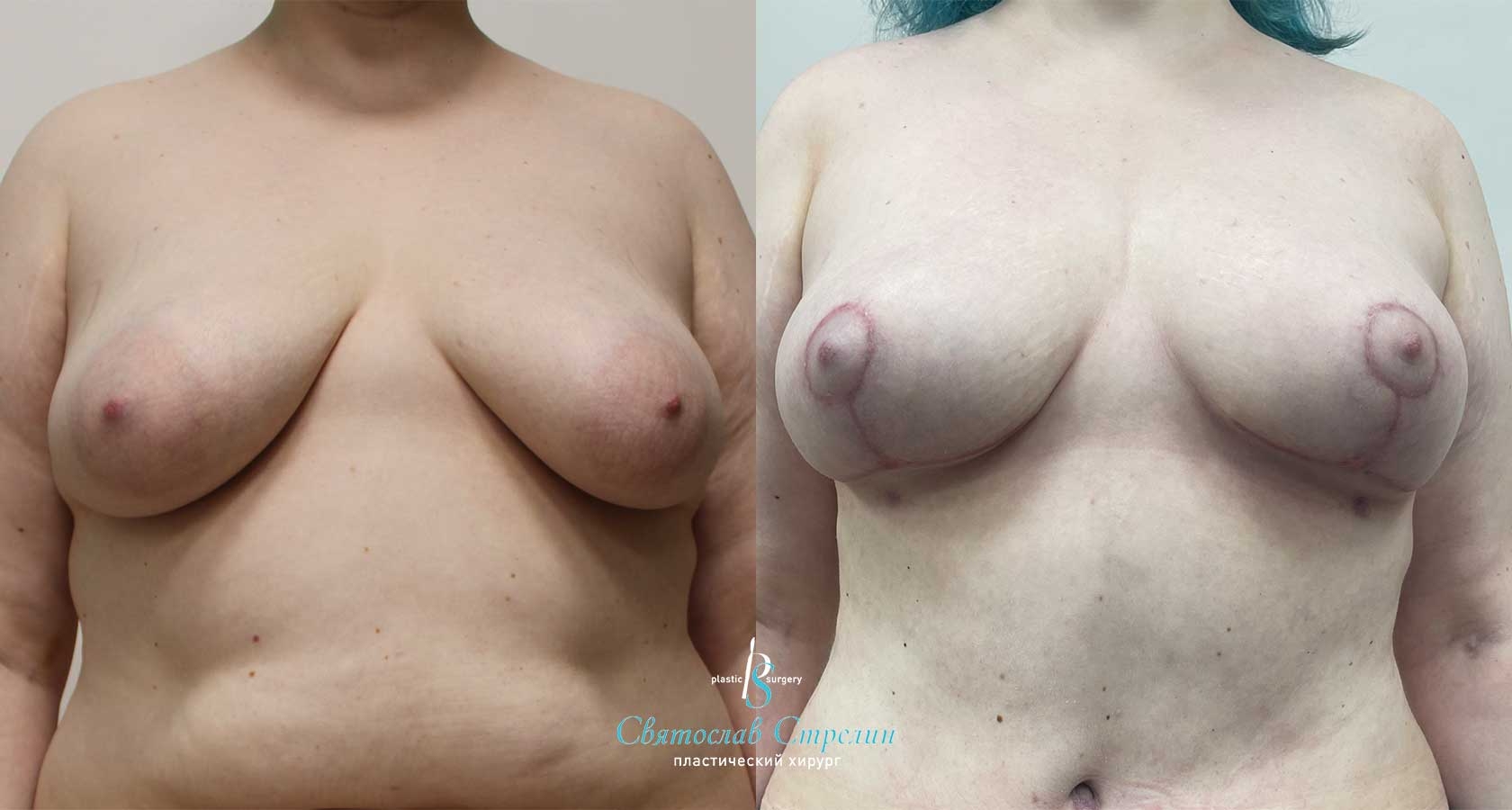 Подтяжка груди, 2 месяца после операции