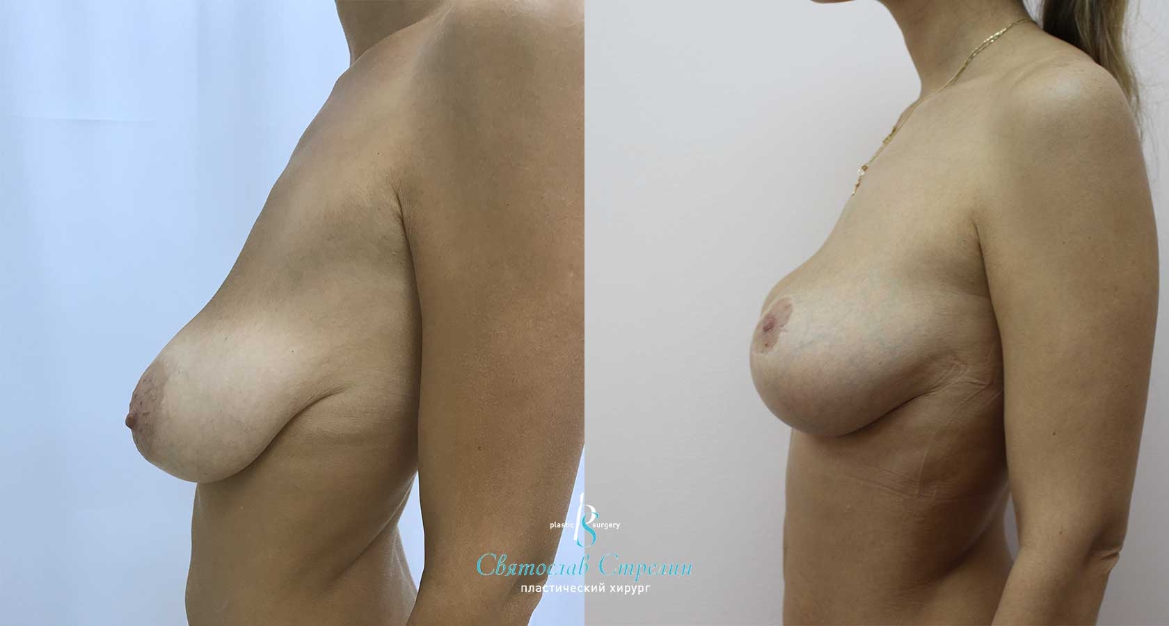 Подтяжка груди, 6 месяцев после операции