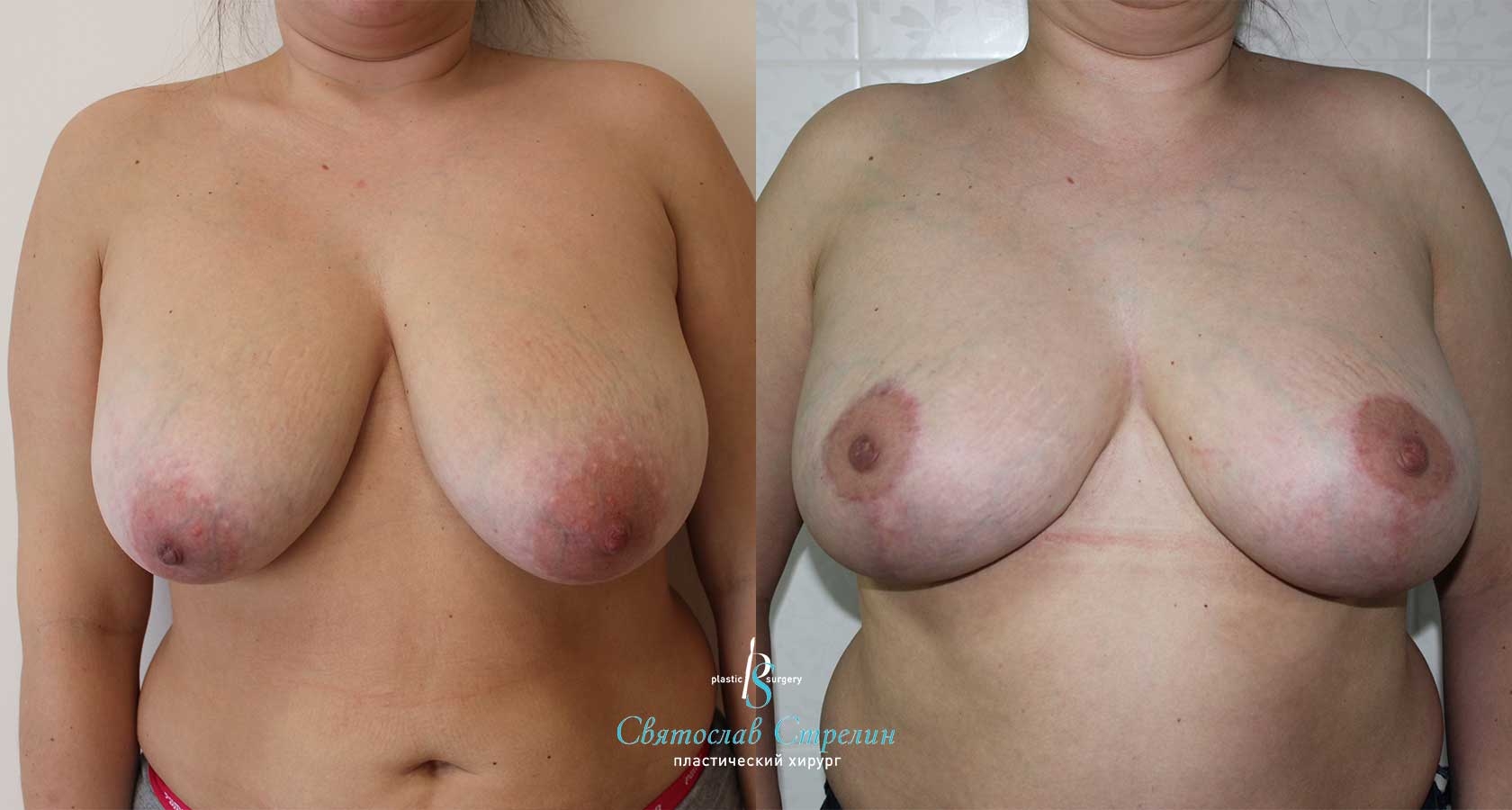 Подтяжка груди, 4 месяца после операции