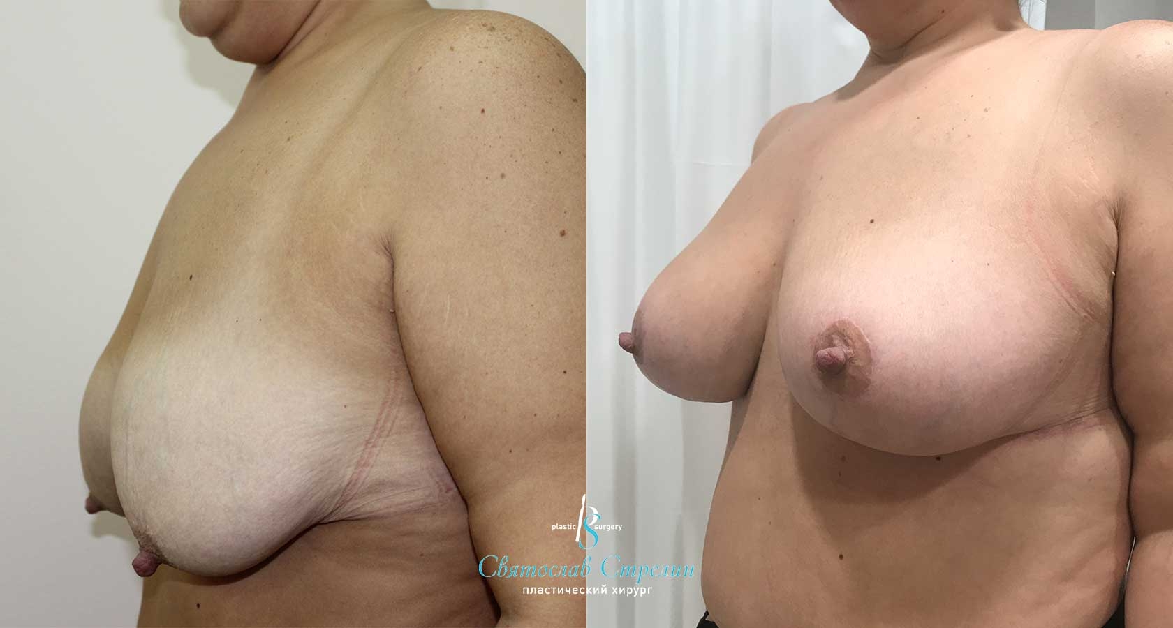 Подтяжка груди, 4 месяца после операции