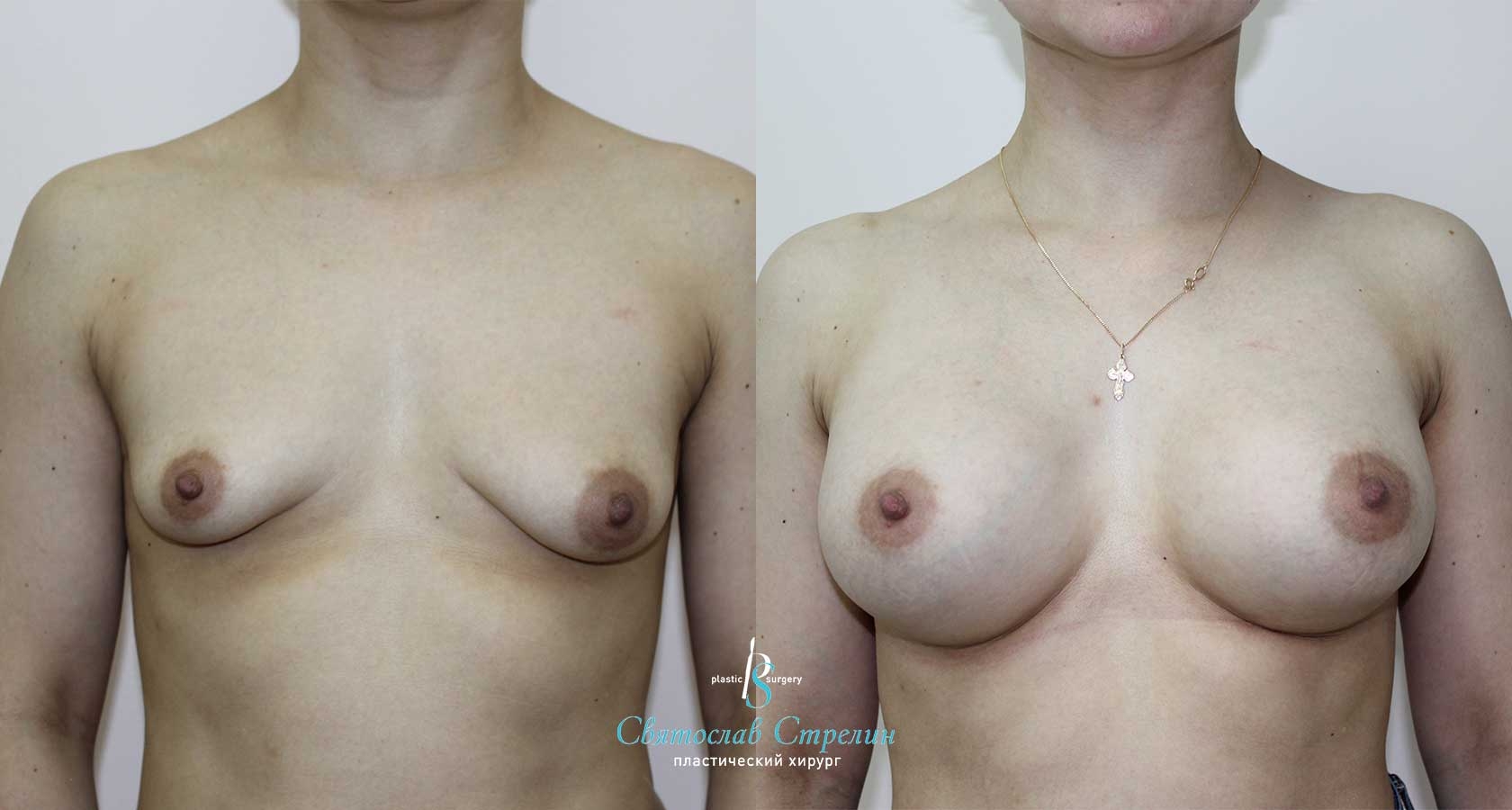 Тубулярная грудь, 7 месяцев после операции. Тубулярность II типа, Себбин 325 мл, анатомические, средняя высота, высокая проекция, доступ подмышечный, эндоскопия
