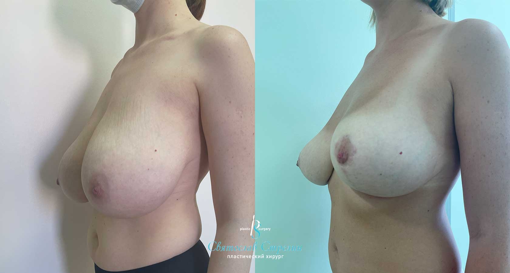Уменьшение груди, 8 месяцев после операции