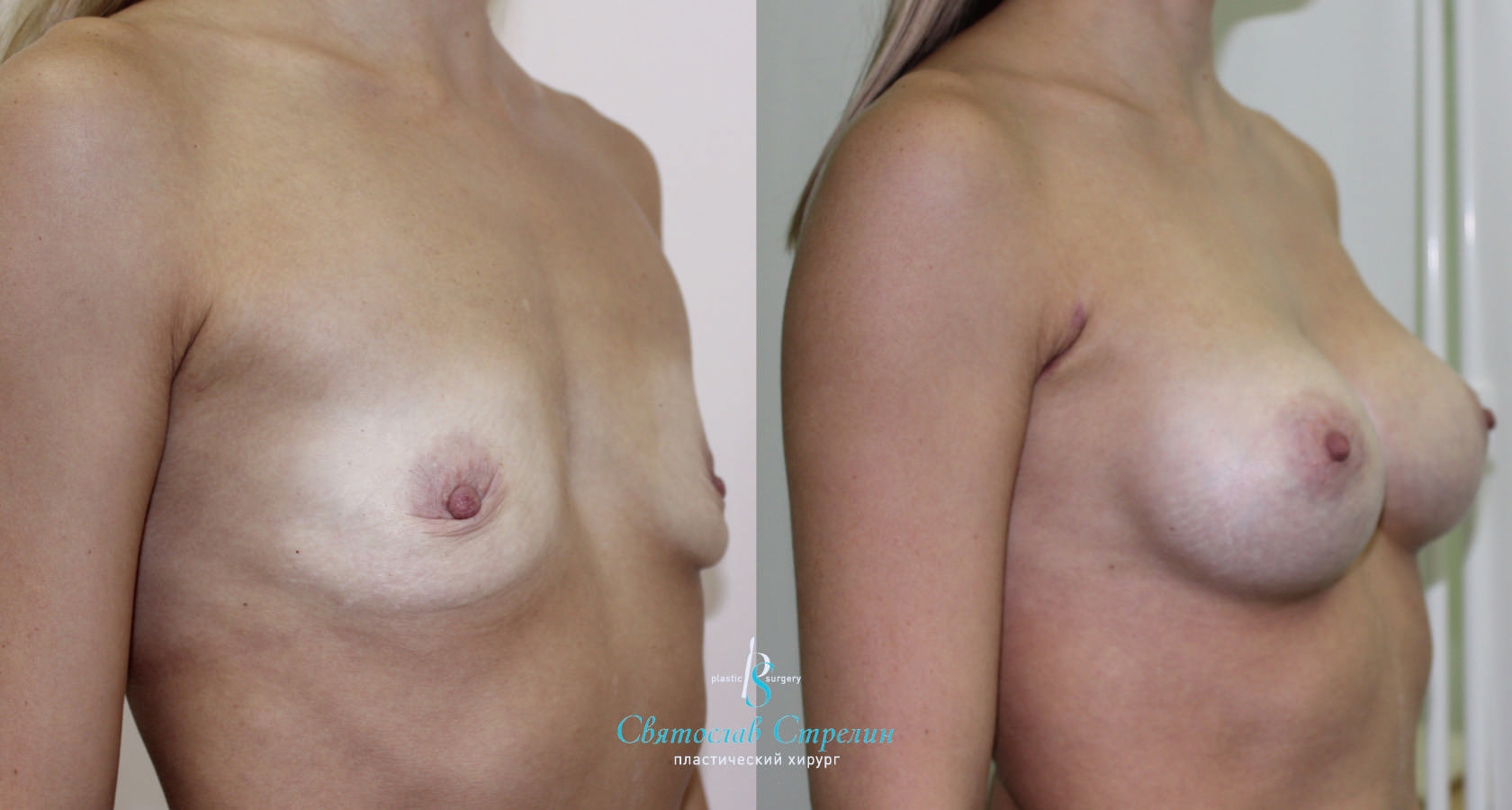Увеличение груди, 2 месяца после операции, импланты Себбин 280 мл, анатомические, средняяв ысота, высокая проекция, доступ подмышечный
