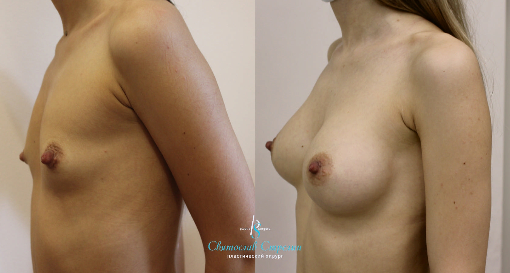 Увеличение груди, 2 года после операции, импланты Себбин 280 мл, анатомические, средняяв ысота, высокая проекция, доступ подмышечный