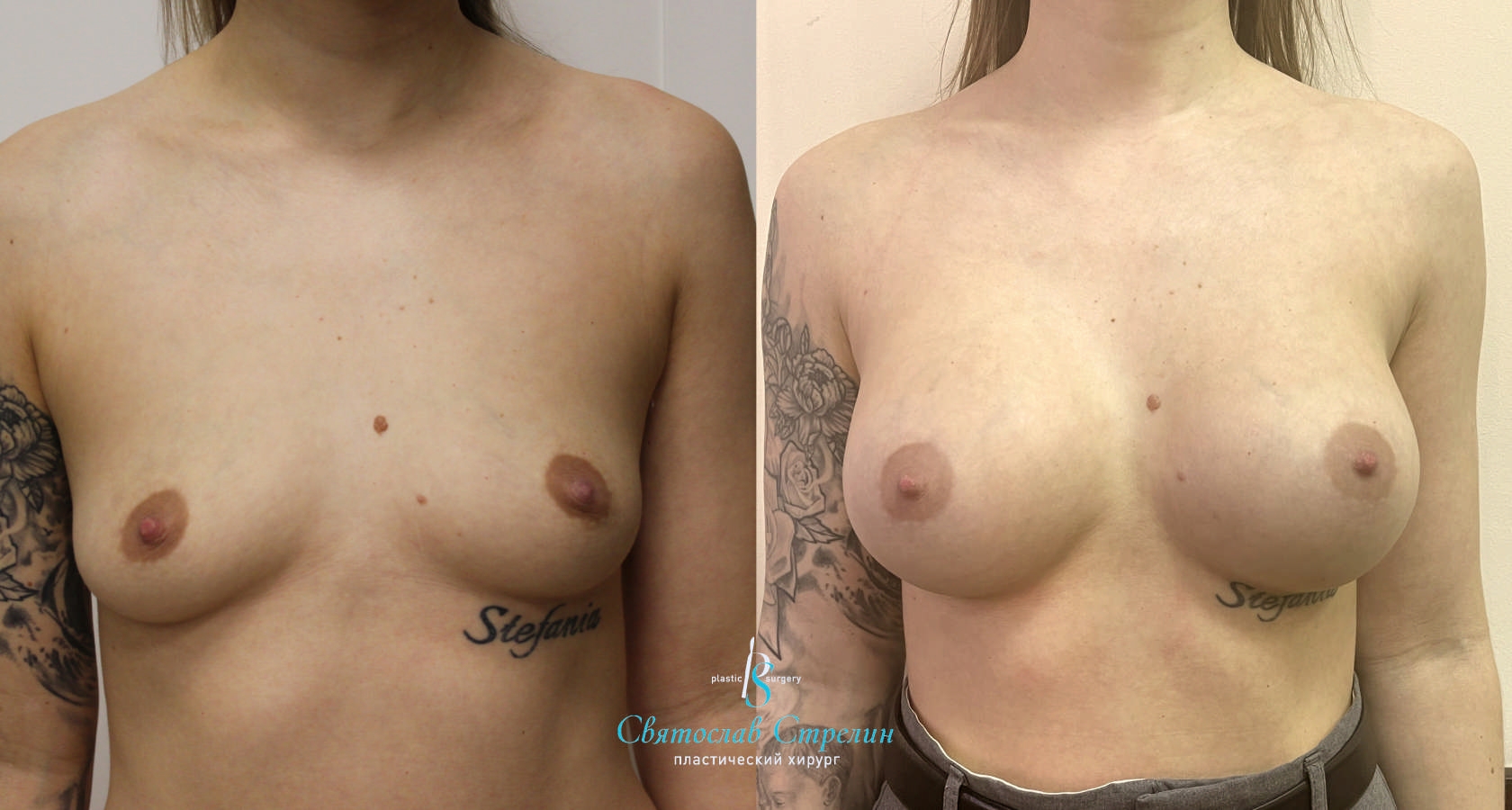 Увеличение груди, 4 месяца после операции, импланты Себбин 370 мл, анатомические, средняяв ысота, высокая проекция, доступ подмышечный