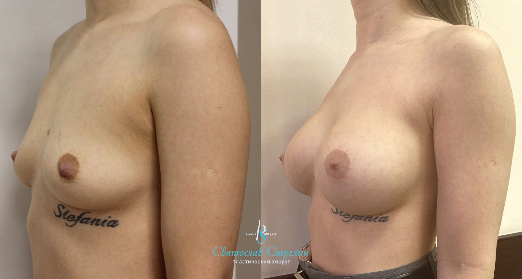 Увеличение груди, 4 месяца после операции, импланты Себбин 370 мл, анатомические, средняяв ысота, высокая проекция, доступ подмышечный