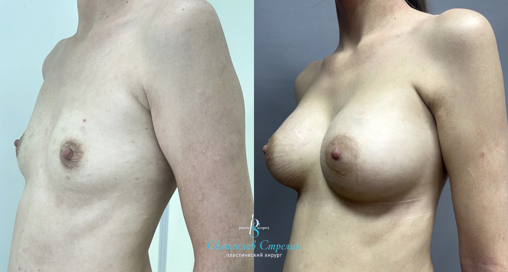 Увеличение груди, 2 месяца после операции, импланты Силимед 320 мл, анатомические, средняяв ысота, высокая проекция, доступ подмышечный