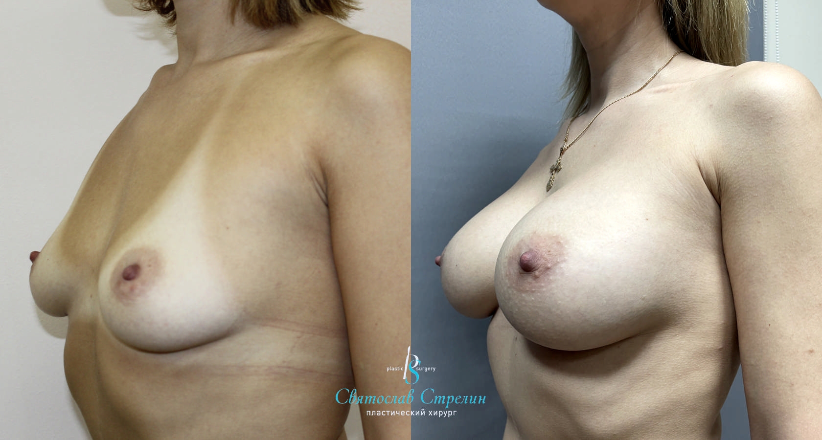 Увеличение груди, 2 года после операции, импланты Себбин 380 мл, анатомические, большая высота, высокая проекция, доступ подмышечный