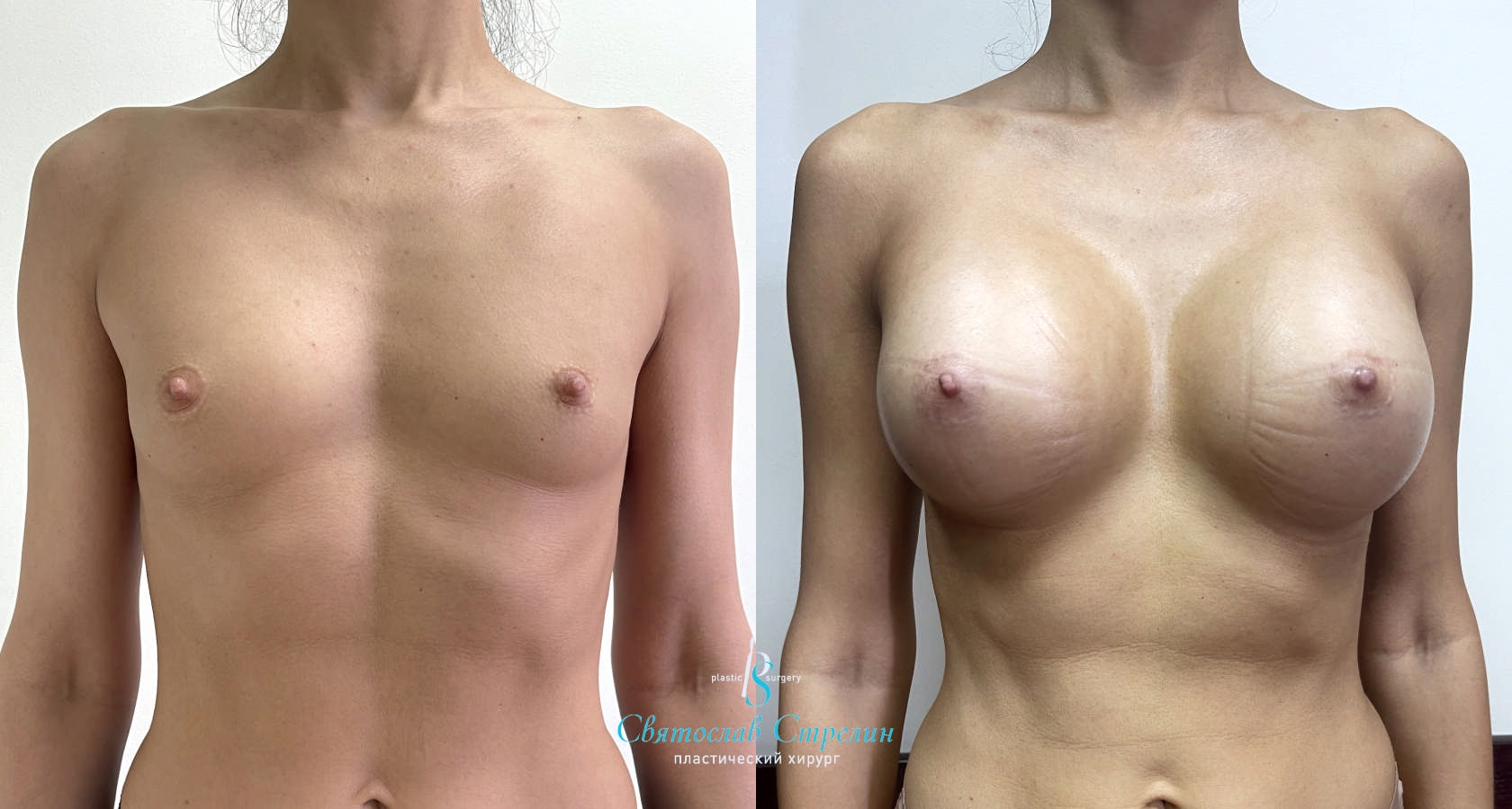 Увеличение груди, 2 месяца после операции, импланты Силимед 370 мл, анатомические, средняяв ысота, высокая проекция, доступ подмышечный