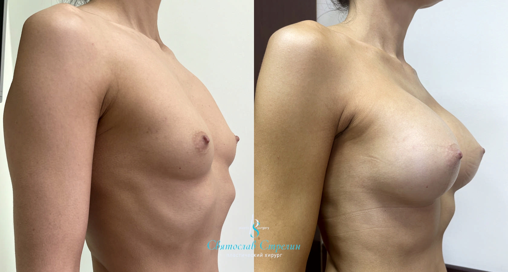 Увеличение груди, 2 месяца после операции, импланты Силимед 370 мл, анатомические, средняяв ысота, высокая проекция, доступ подмышечный