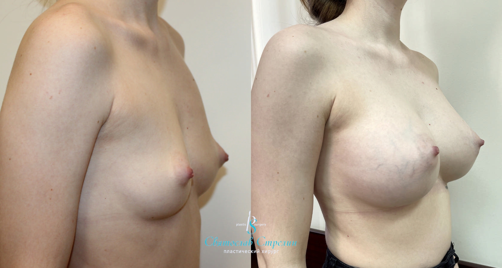 Увеличение груди, 6 месяцев после операции, импланты Силимед 320 мл, анатомические, средняяв ысота, средняя проекция, доступ подмышечный
