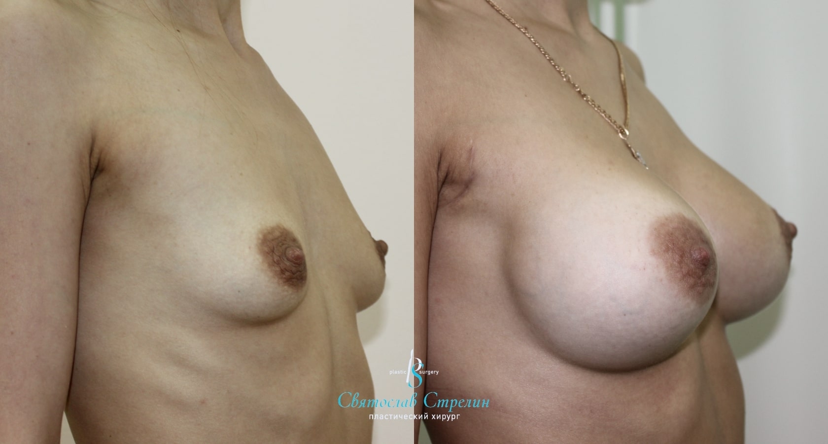 Увеличение груди, 8 месяцев после операции, импланты Себбин 280 мл, анатомические, средняяв ысота, высокая проекция, доступ подмышечный