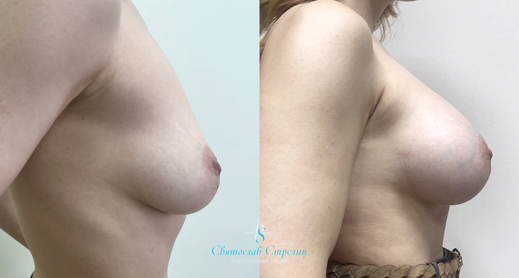 Увеличение груди, 6 месяцев после операции, импланты Себбин 425 мл, анатомические, большая высота, высокая проекция, доступ подмышечный