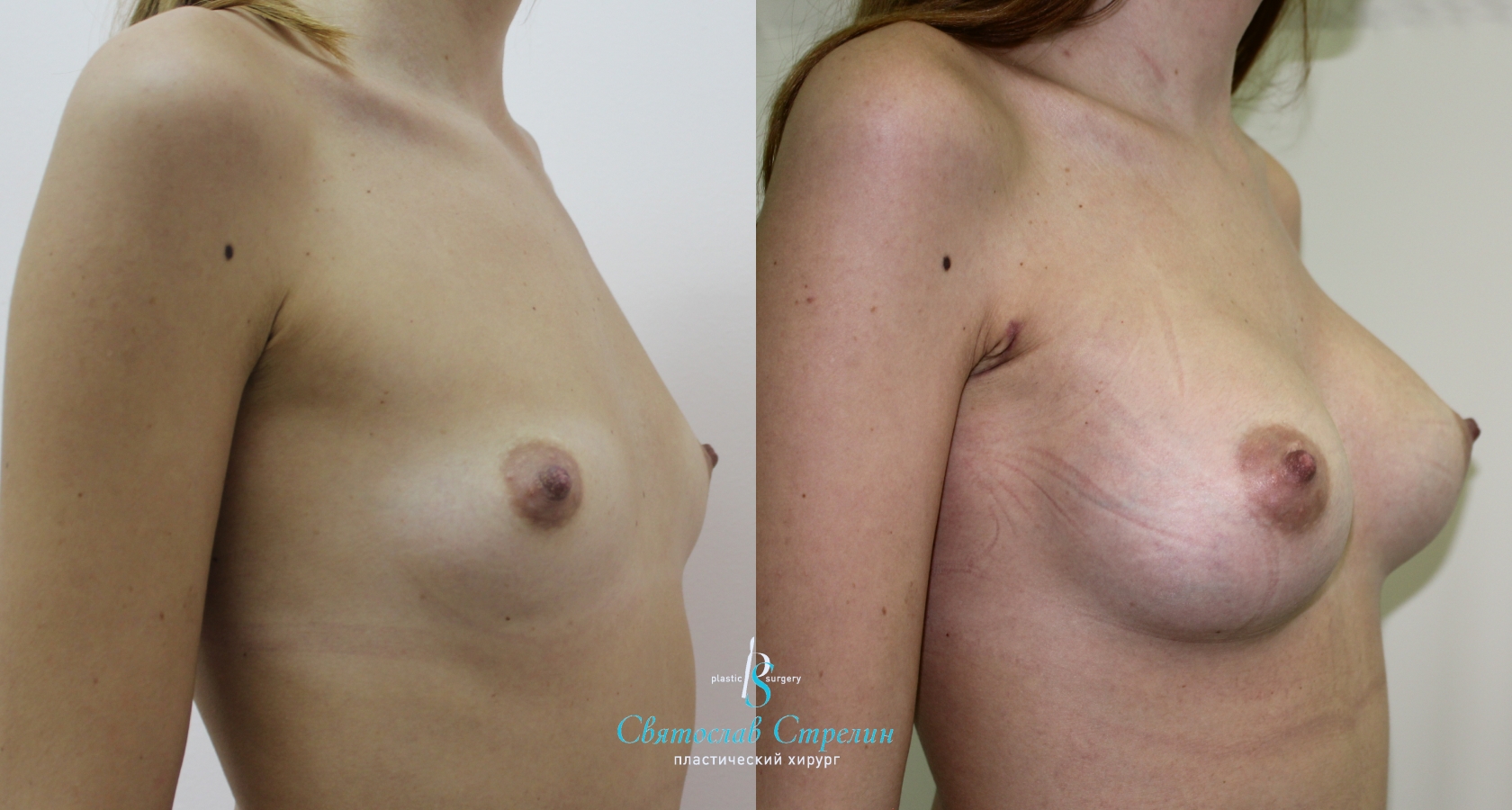 Увеличение груди, 2 месяца после операции, импланты Силимед 370 мл, анатомические, средняя высота, высокая проекция, доступ подмышечный