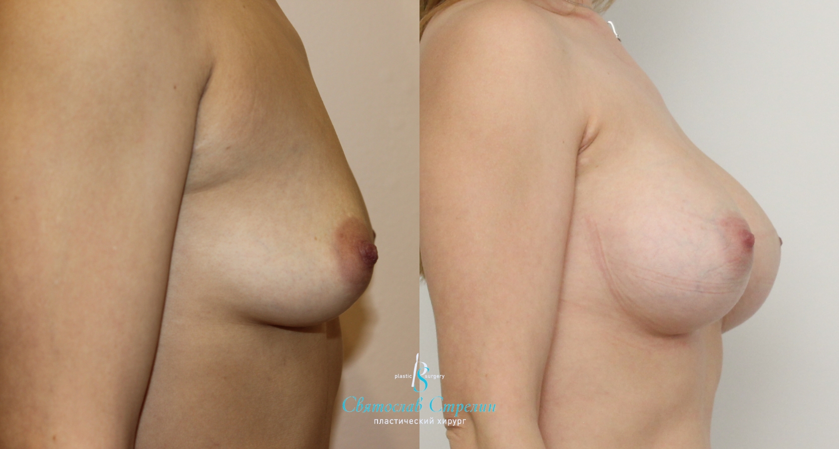 Увеличение груди, 10 месяцев после операции, импланты Силимед 380 мл, анатомические, большая высота, высокая проекция, доступ подмышечный