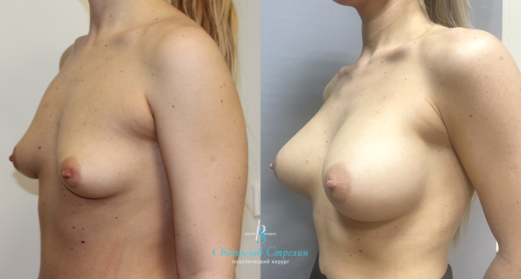 Увеличение груди, 1,5 года после операции, импланты Себбин 380 и 425 мл, анатомические, большая высота, высокая проекция, доступ подмышечный