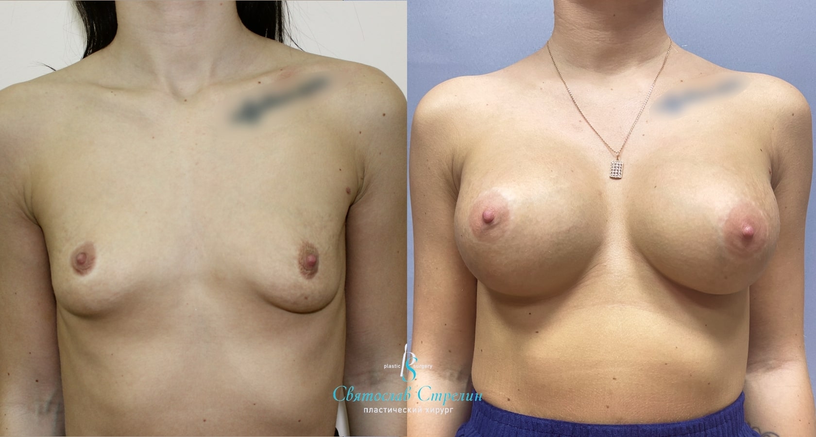 Увеличение груди, 5 лет после операции, импланты Себбин  365 мл, круглые, высокая проекция, подмышечныйдоступ