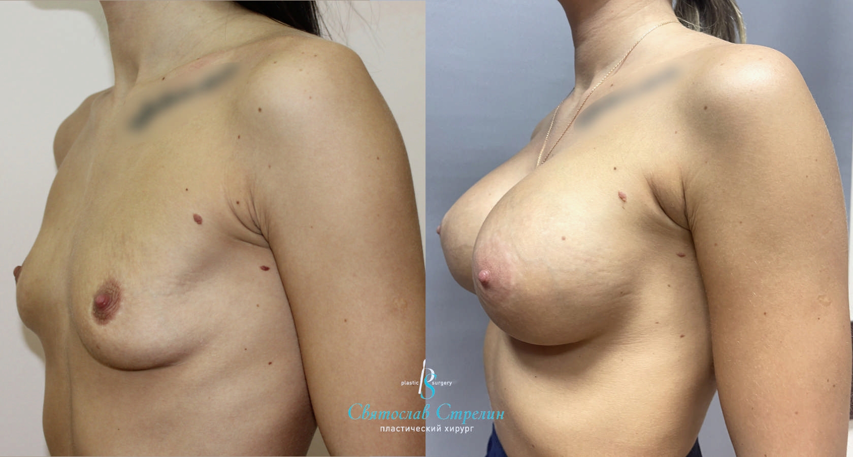 Увеличение груди, 5 лет после операции, импланты Себбин  365 мл, круглые, высокая проекция, подмышечныйдоступ