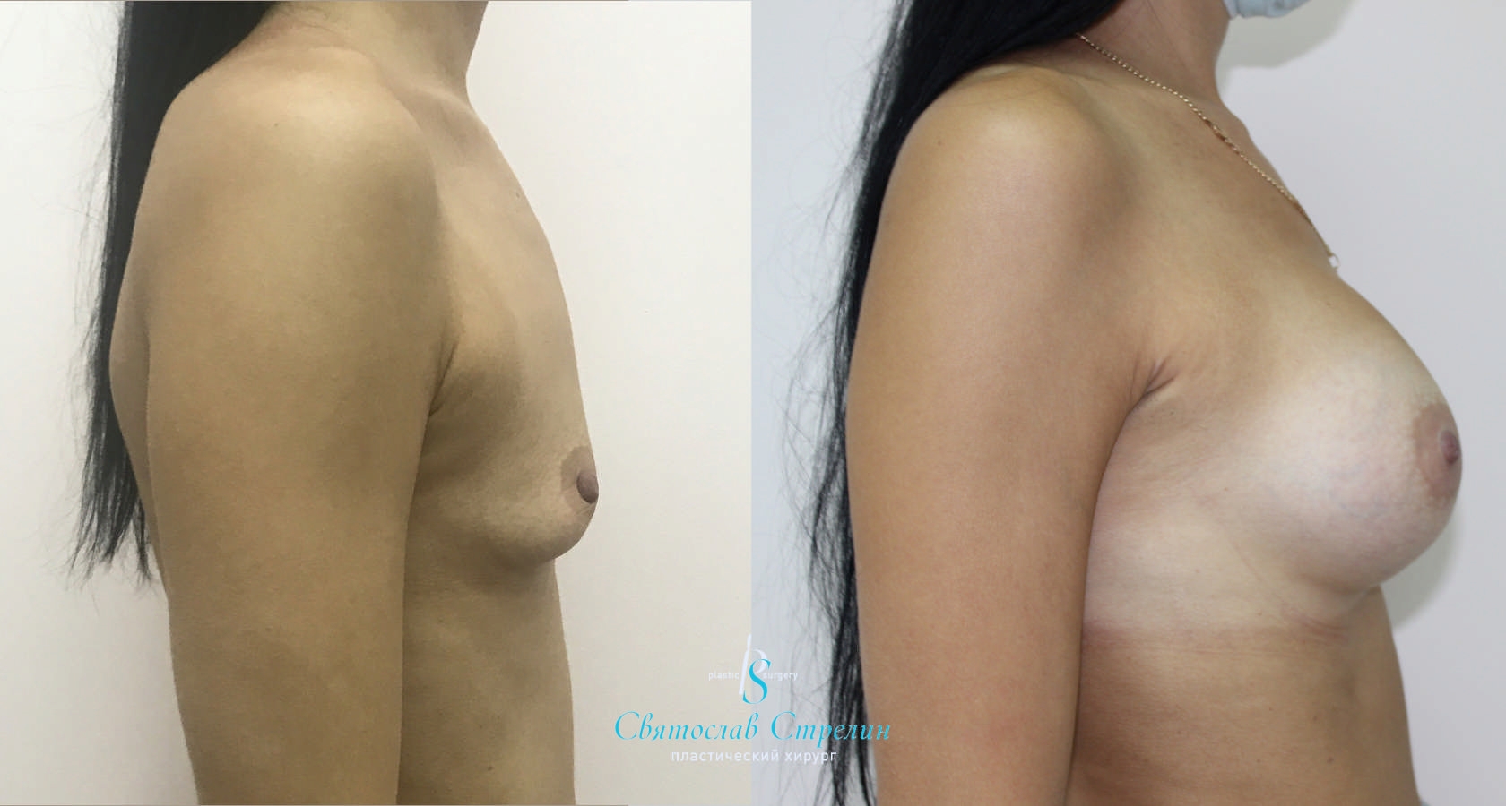 Увеличение груди, 6 месяцев после операции, импланты Себбин 380 мл, анатомические, большая высота, высокая проекция, доступ подмышечный
