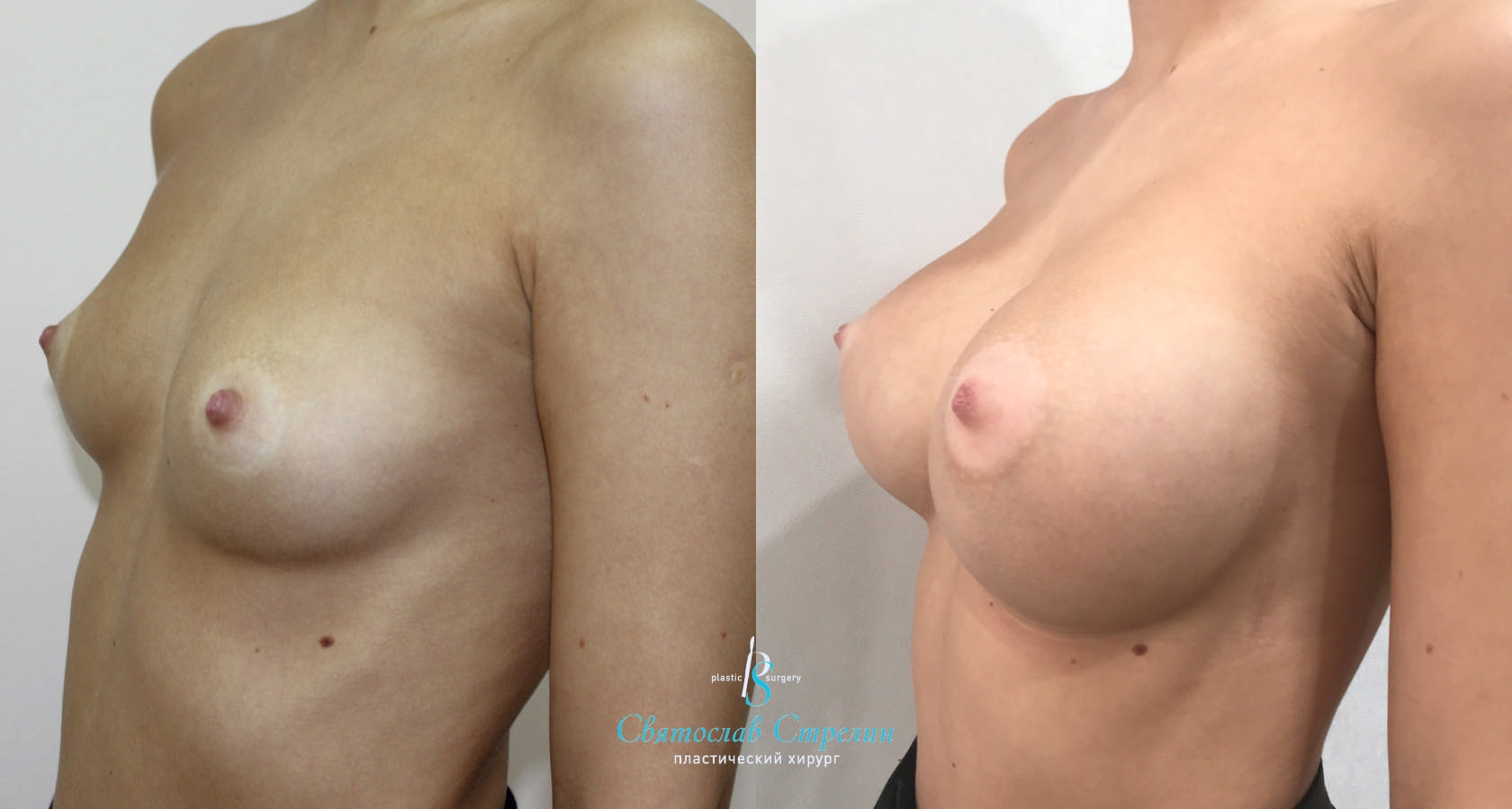 Увеличение груди, 1 год после операции, импланты Себбин 415 мл, анатомические, средняяв ысота, высокая проекция, доступ подмышечный