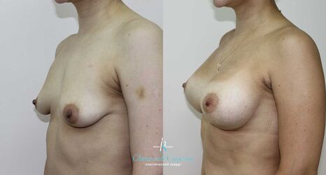 Тубулярная грудь, 7 месяцев после операции. Тубулярность II типа, Себбин 325 мл, анатомические, средняя высота, высокая проекция, доступ подмышечный, эндоскопия