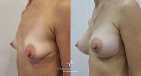 Тубулярная грудь, 7 месяцев после операции. Тубулярность III типа, Себбин 365 мл, анатомические, средняя высота, высокая проекция, доступ подмышечный, эндоскопия