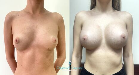 Увеличение груди, 1 месяц после операции, импланты Силимед 475 мл, анатомические, средняяв ысота, средняя проекция, доступ подмышечный