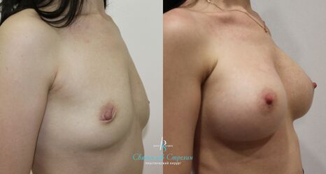Увеличение груди, 3 месяца после операции, импланты Себбин 480 мл, анатомические, большая высота, высокая проекция, доступ подмышечный