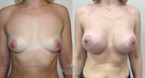 Увеличение груди, 2 месяца после операции, импланты Силимед 410 мл, анатомические, средняяв ысота, высокая проекция, доступ подмышечный
