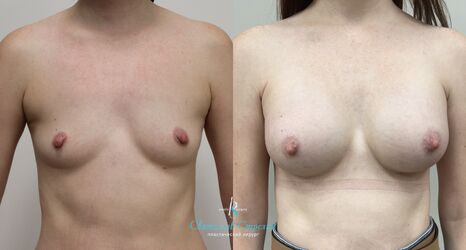 Увеличение груди, 2 месяца после операции, импланты Силимед 320 мл, анатомические, средняяв ысота, высокая проекция, доступ подмышечный