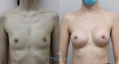 Увеличение груди, 8 месяцев после операции, импланты Себбин 245 мл, анатомические, средняяв ысота, высокая проекция, доступ подмышечный