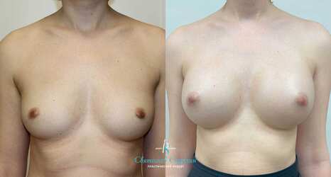 Увеличение груди, 1 год после операции, импланты Себбин 375 мл, анатомические, большая высота, средняя проекция, доступ подмышечный