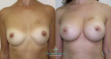 Увеличение груди, 6 месяцев после операции, импланты Себбин 335 мл, анатомические, большая высота, высокая проекция, доступ подмышечный