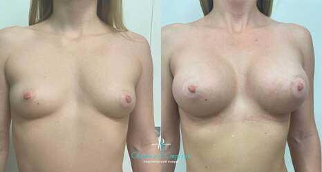 Увеличение груди, 4 месяца после операции, импланты Себбин 415 мл, анатомические, средняя высота, высокая проекция, доступ подмышечный