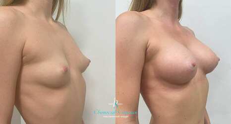Увеличение груди, 4 месяца после операции, импланты Себбин 415 мл, анатомические, средняя высота, высокая проекция, доступ подмышечный