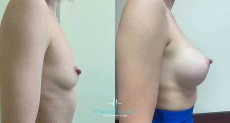 Увеличение груди, 6 месяцев после операции, импланты Себбин 380 мл, анатомические, большая высота, высокая проекция, доступ подмышечный