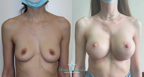 Увеличение груди, 3 месяца после операции, импланты Себбин 335 мл, анатомические, большая высота, высокая проекция, доступ подмышечный