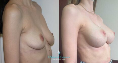 Увеличение груди, 3 месяца после операции, импланты Себбин 335 мл, анатомические, большая высота, высокая проекция, доступ подмышечный