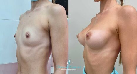 Увеличение груди, 1 год после операции, импланты Себбин 280 мл, анатомические, средняяв ысота, высокая проекция, доступ подмышечный