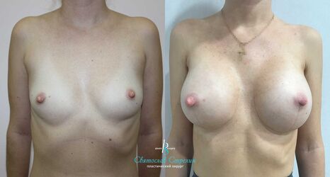 Увеличение груди, 3 месяца после операции, импланты Себбин 335 мл слева и 380 мл, справа анатомические, доступ подмышечный