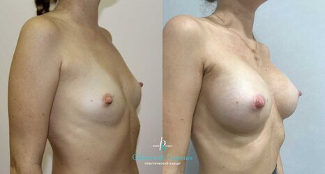 Увеличение груди, 3 месяца после операции, импланты Себбин 335 мл слева и 380 мл, справа анатомические, доступ подмышечный