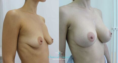 Увеличение груди, 1 год после операции, импланты Себбин 370 мл, анатомические, средняяв ысота, высокая проекция, доступ подмышечный