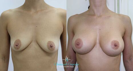 Увеличение груди, 1 год после операции, импланты Себбин 370 мл, анатомические, средняяв ысота, высокая проекция, доступ подмышечный
