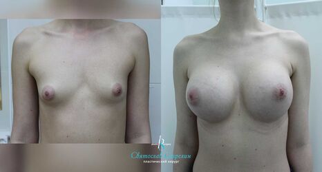 Увеличение груди, 6 месяцев после операции, импланты Себбин 415 мл, круглые, высокая проекция, доступ подмышечный